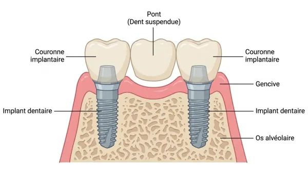 Schéma d'un bridge sur deux implants dentaires avec pont suspendu, gencive et os alvéolaire
