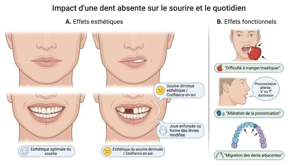 Schéma des effets esthétiques et fonctionnels d'une dent absente sur le sourire, la mastication et la prononciation